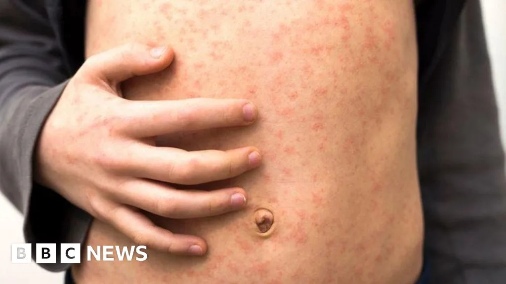Measles warning for holidaymakers heading to Europe